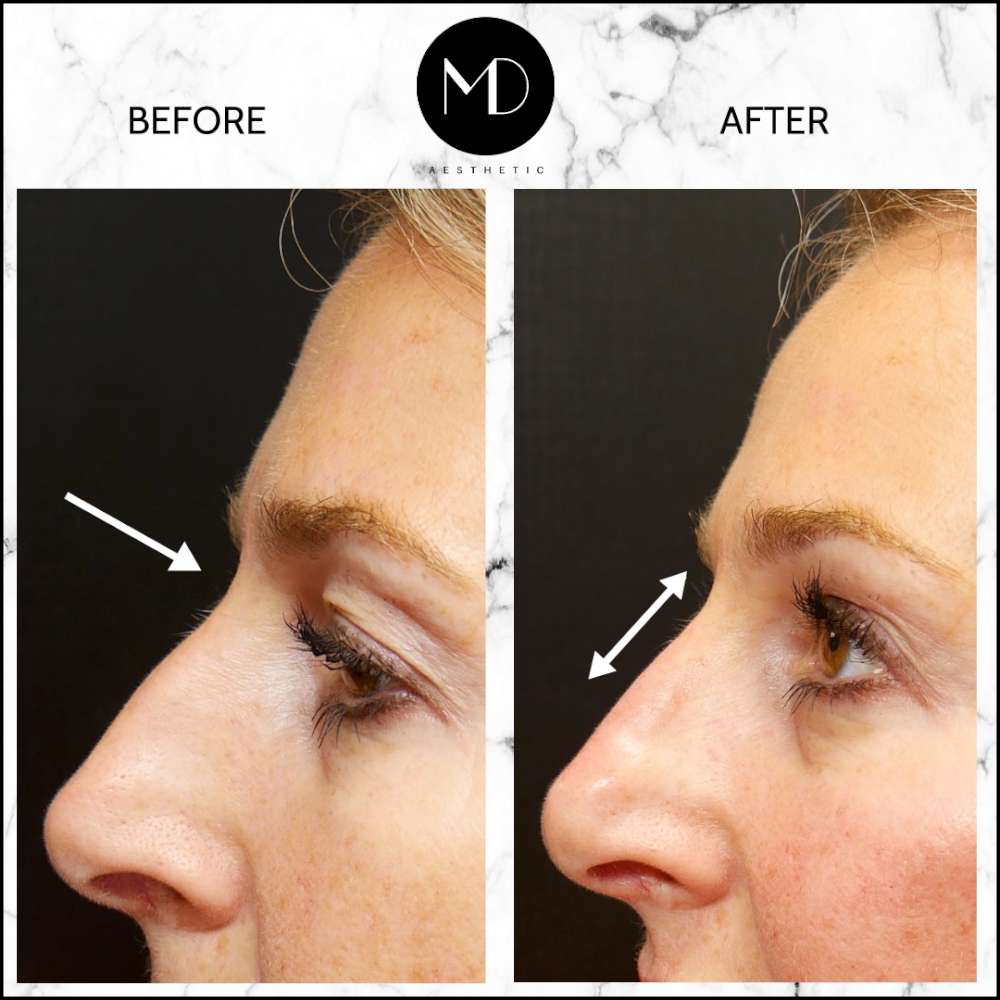 Nose Reshaping Md Aesthetic nose reshaping md aesthetic
